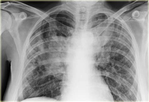 The Radiology Assistant : Chest X-Ray - Lung disease