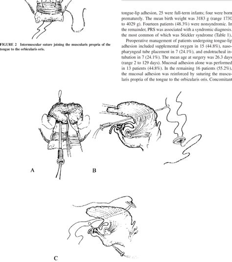 Senior author's technique for retention suture placement. | Download Scientific Diagram