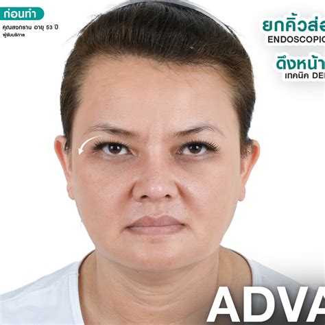 Advance Fullface Lift Masterpiece Hospital