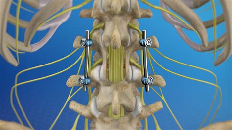 Plif Minimally Invasive Posterior Lumbar Interbody Fusion Plif