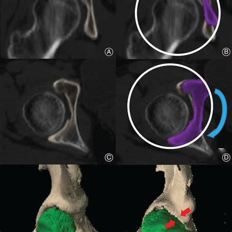 Preoperative Planning Views From Computed Navigation Guidance A