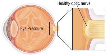 Optic Nerve Swelling (Papilledema) Guide: Causes, Symptoms and ...