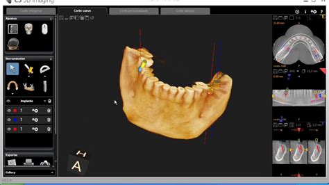 Tutorial Cs D Imaging Software Carestream Simulacion De Implantes