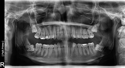 Tomografia Z B W Cefalometria Pantomogram Cbct Stomatologia