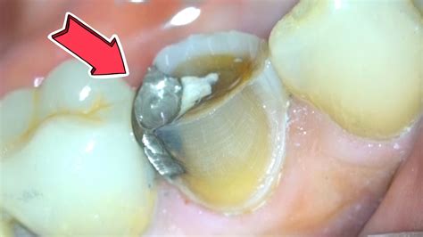 Dental Crown Procedure { Zirconia Crown Preparation w/ Microscope } - Dental Clinic