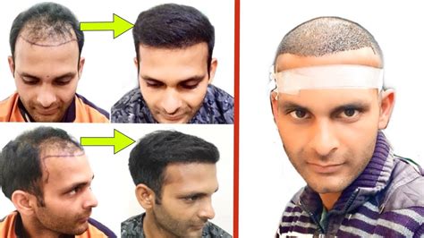 Case Study Before To 4 Month Amazing Hair Transplant Result Hair