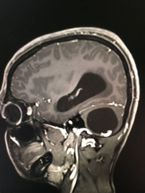 Hemangioblastoma Radiology Imaging Radiology Mri