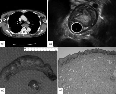 Giant Fibrovascular Polyp Of The Esophagus With Intermittent