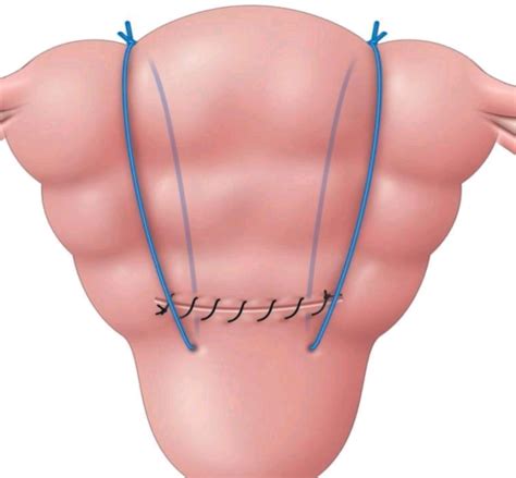 Important Uterine Sutures Against Atony Meduweb