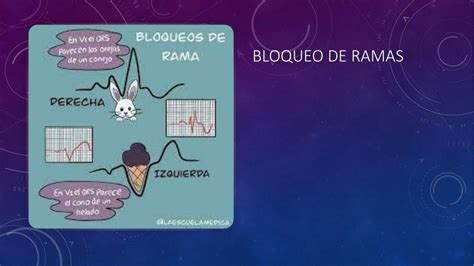 Resúmenes de Bloqueos de rama Descarga apuntes de Bloqueos de rama