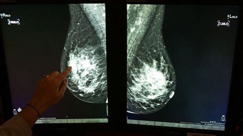 What Our Patients With Dense Breasts Deserve To Know MedPage Today