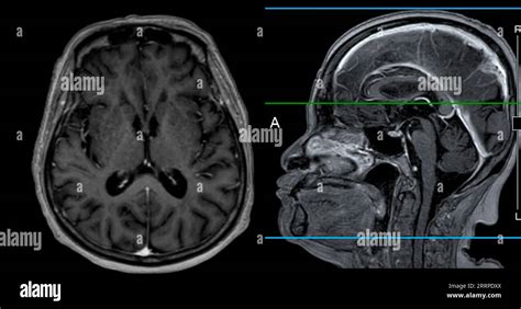 Hippocampus Mri Sagittal