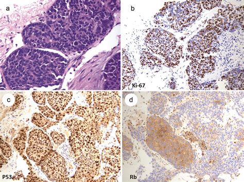 Differential Diagnosis Of High Grade Neuroendocrine Neoplasms In The