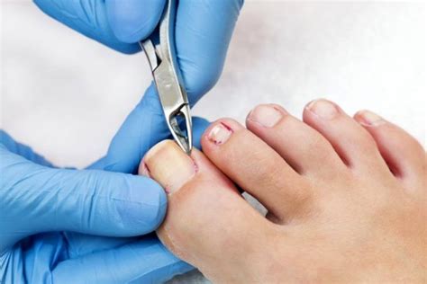 After Care Of Ingrown Toenail Removal Toenail Ingrown Infected Removal