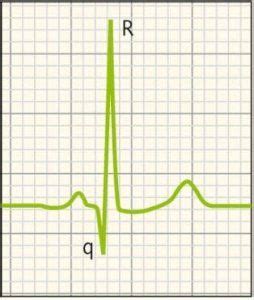 Eje Card Aco Como Calcular El Eje Card Aco En El Ekg Paso A Paso