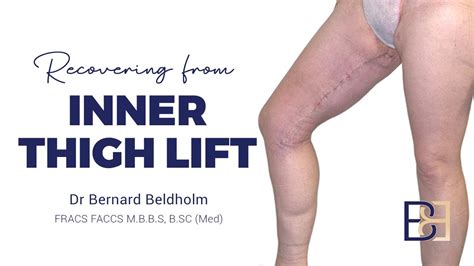 Recovering From Inner Thigh Lift Youtube