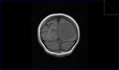 Meningioma MRI