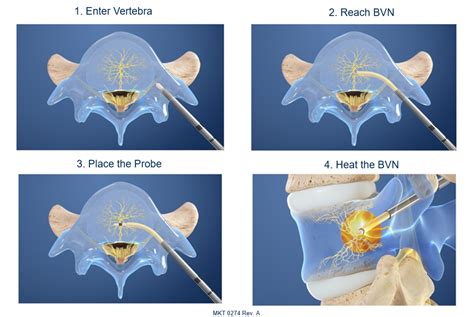 Intracept Procedure Restore Medical Partners Venice FL