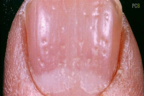 15 Health WARNINGS Your Fingernails May Be Sending