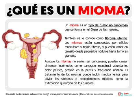 Qué Es Un Mioma Definición De Mioma