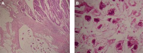 Specimen Pathology Showing A Mucinous Adenocarcinoma In Ileal Mucosa