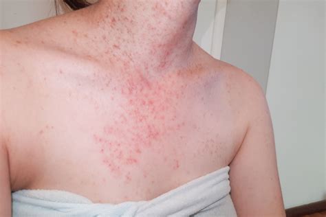 Folliculitis Causes And Treatment Options Nbkomputer