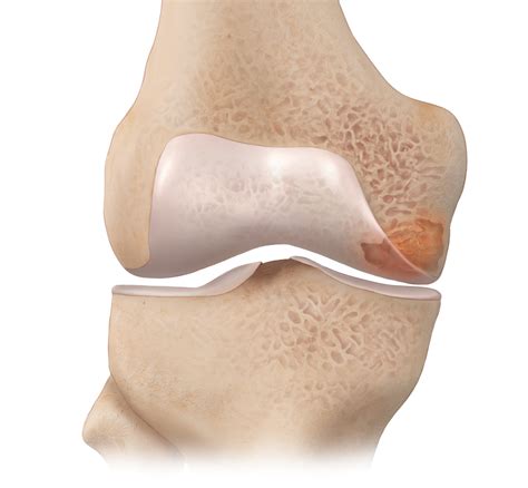 Arthrex Intraosseous Bioplasty Iobp Technique