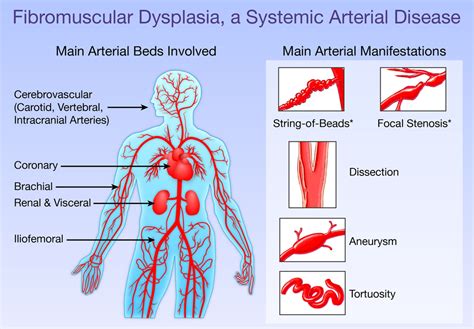 Fibromuscular Dysplasia Carotid Artery