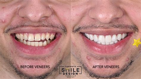 Transforming Smiles A Journey From Yellow Teeth To Bright Beautiful