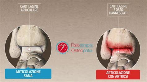 Lartrosi della caviglia cosè e come curarla Centro di