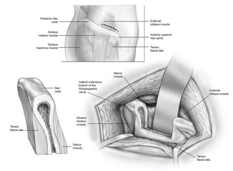 Iliac Crest Bone Harvest Dr Paul Mirdamadi Dds