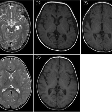 Brain Mri Scans Showed Slight Changes Choroid Plexus Cysts In The | Hot Sex Picture