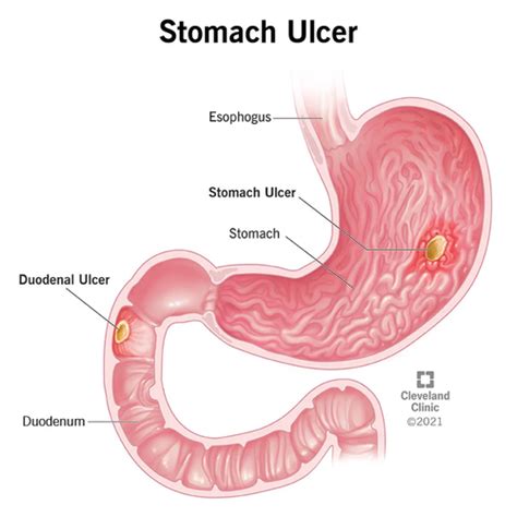 Peptic Ulcer Disease Flashcards Quizlet