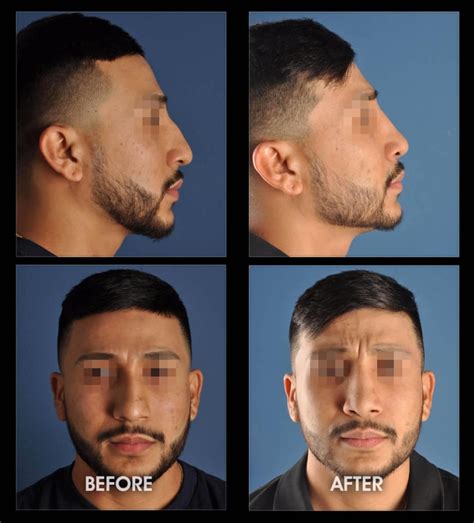 Male Rhinoplasty Before And After Photos Los Angeles