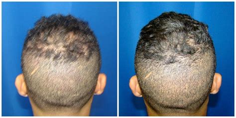 Patient 191 NeoGraft Before And After Photos Houston TX Plastic