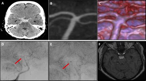 Perimesencephalic Subarachnoid Hemorrhage With A Positive Angiographic