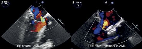 Percutaneous Treatment Of Anterior Mitral Leaflet Perforation Using An