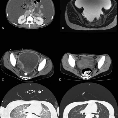 A Contrast Enhanced CT Of The Abdomen Shows Gross Ascites With No