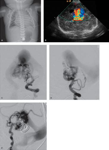 Vein of Galen Malformations | Neupsy Key