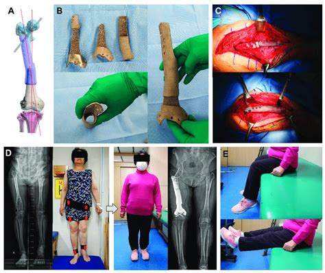 Revision Limb Salvage Surgery Using 3d Printed Connector In The Femur