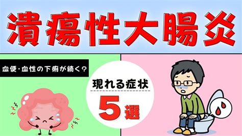 【潰瘍性大腸炎になると現れる症状5選！】 その症状は 潰瘍性大腸炎 のサインかも？ （おがちゃん先生） エキスパート Yahoo ニュース