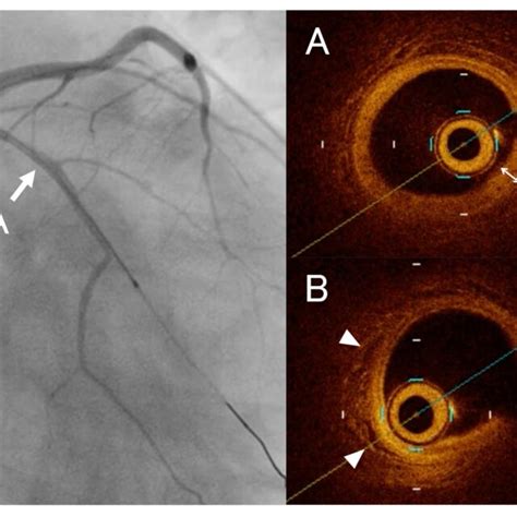10000 Pdfs Review Articles In Mucocutaneous Lymph Node Syndrome