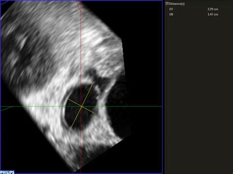 Application Of Three Dimensional Ultrasound In Left Atrial Appendage