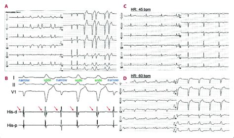 Twelve Lead Electrocardiograms Ecgs Before A And After C D Download Scientific Diagram