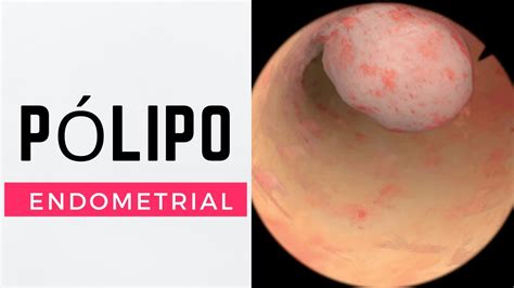 COMO SE TRATA UM PÓLIPO ENDOMETRIAL YouTube