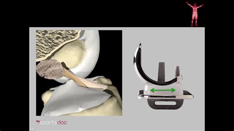 Oxford Unicompartmental Knee Alternative To Knee Replacement YouTube