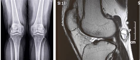 Knee Cartilage Damage Repair Clinic Cartilage Regeneration