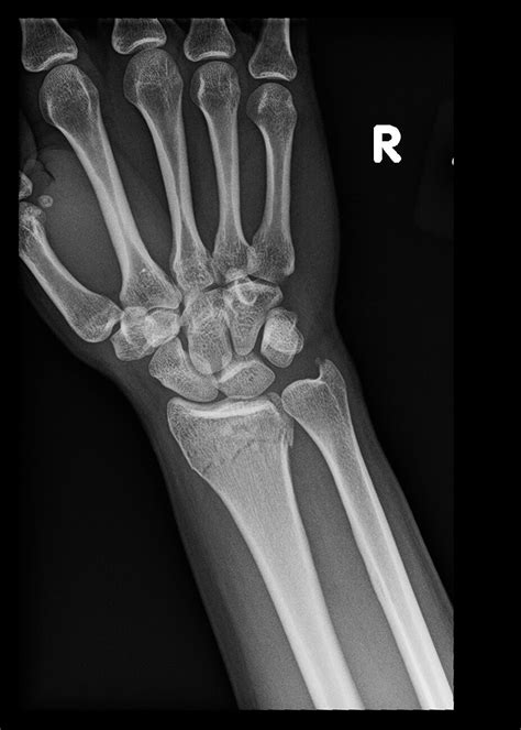 Extensor Pollicis Longus Rupture