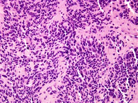 Pathology Outlines Neuroblastoma