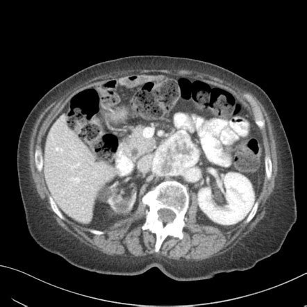 Paraganglioma - organ of Zuckerkandl | Image | Radiopaedia.org